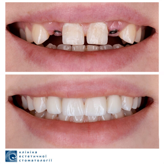 Dental Implantation or Prosthetic Rehabilitation: What to Choose photo