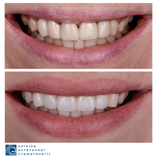 Dental Implantation or Prosthetic Rehabilitation: What to Choose photo