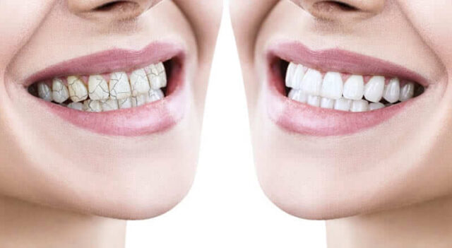 Tooth Decay: Causes and Treatment