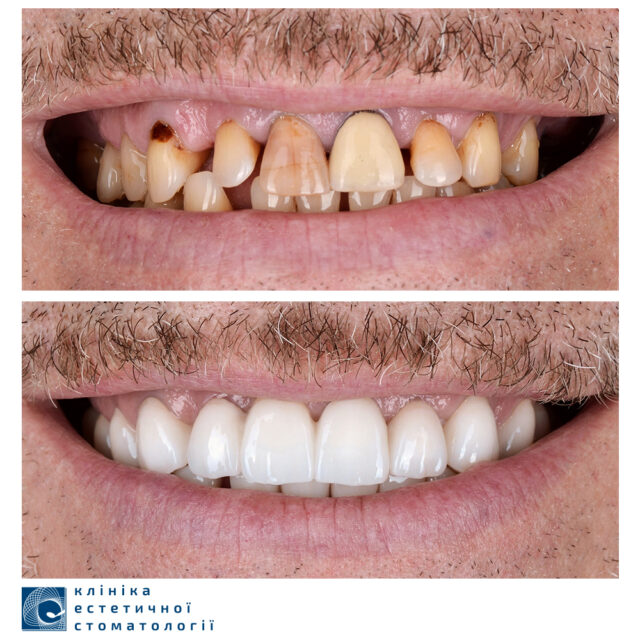 Tooth Decay: Causes and Treatment photo