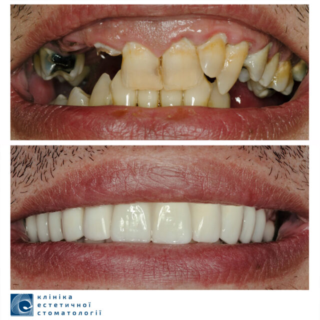 Dental Implants: How Are Dental Implants Placed photo