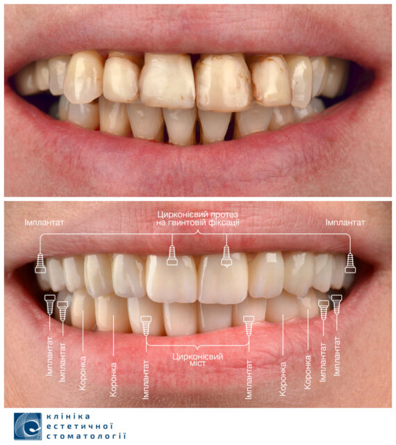 Dental Implants: How Are Dental Implants Placed photo