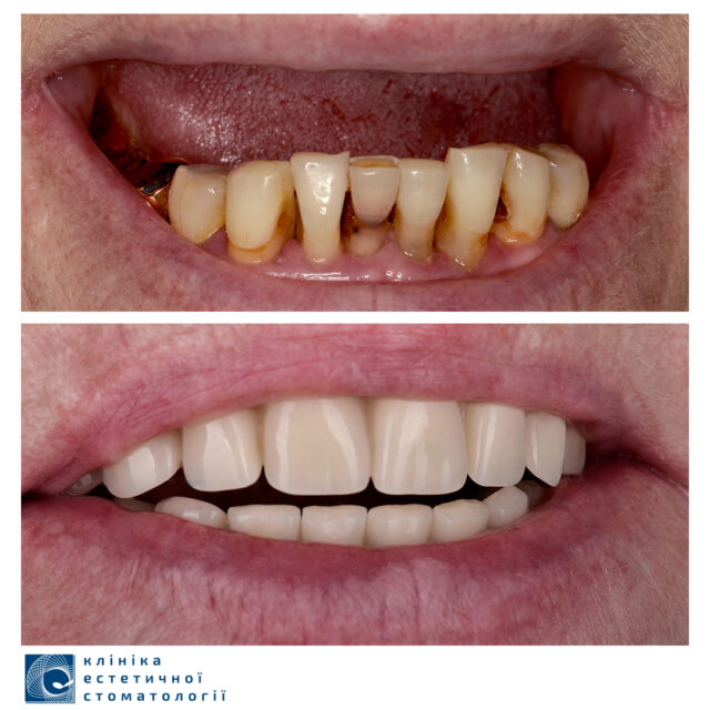 Имплантация верхней челюсти фото