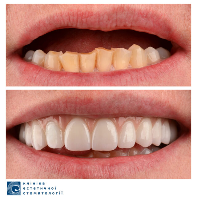 Имплантация верхней челюсти фото