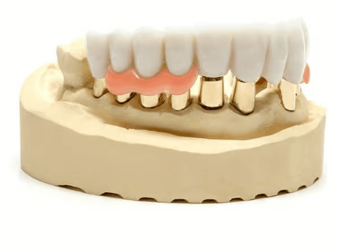 Telescopic denture Illustration