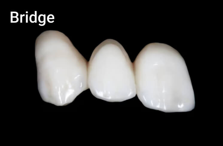 Indirect restoration. Photo 3