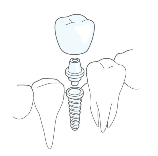 Implantation Illustration