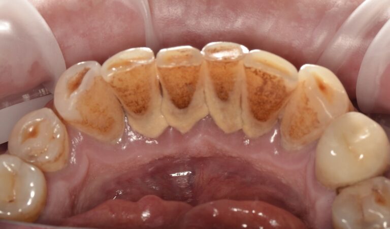 WHAT IS THE DANGER OF PLAQUE AND TARTAR?. Photo before