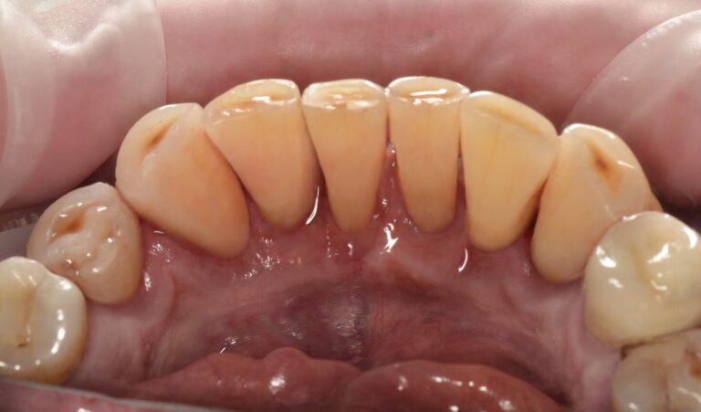 WHAT IS THE DANGER OF PLAQUE AND TARTAR?. Photo after