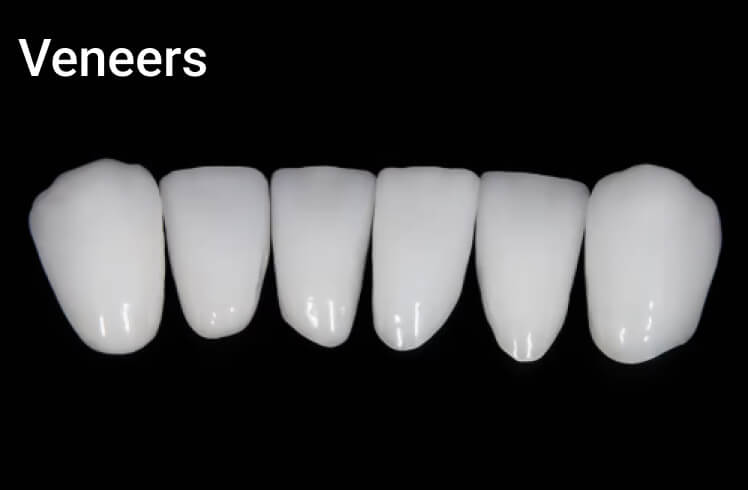 Indirect restoration. Photo 2