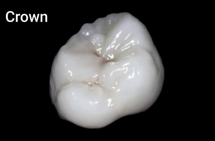 Indirect restoration. Photo 4