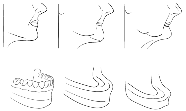 Показання та протипоказання до проведення імплантації Ілюстрація