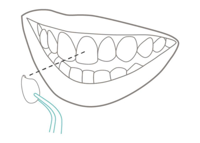 Installation of Veneers Illustration