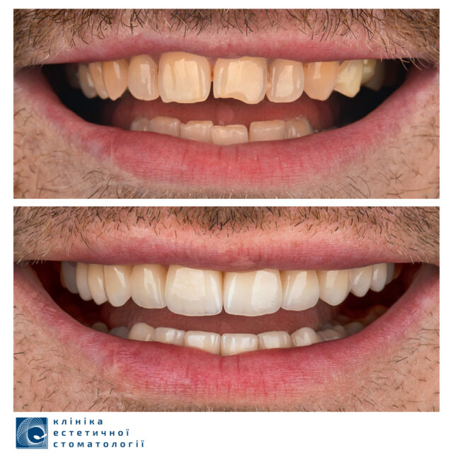 What To Do if You Have Chipped a Tooth photo