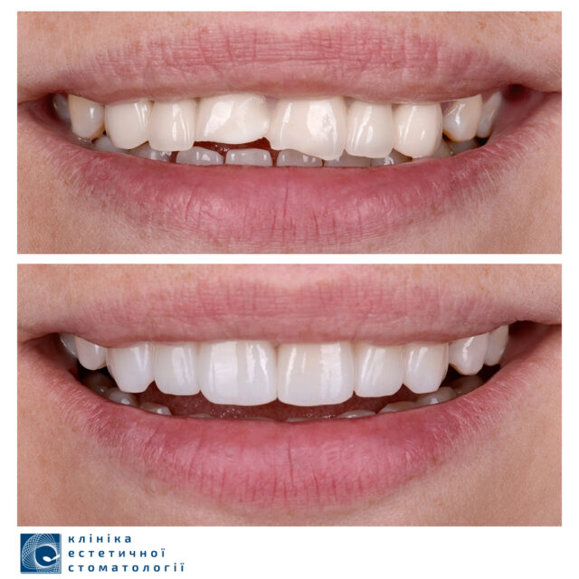 What To Do if You Have Chipped a Tooth photo