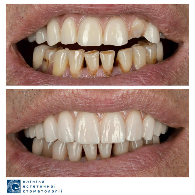 What To Do if You Have Chipped a Tooth photo