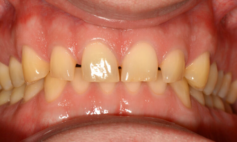 Posterior Composite Restoration. Photo before