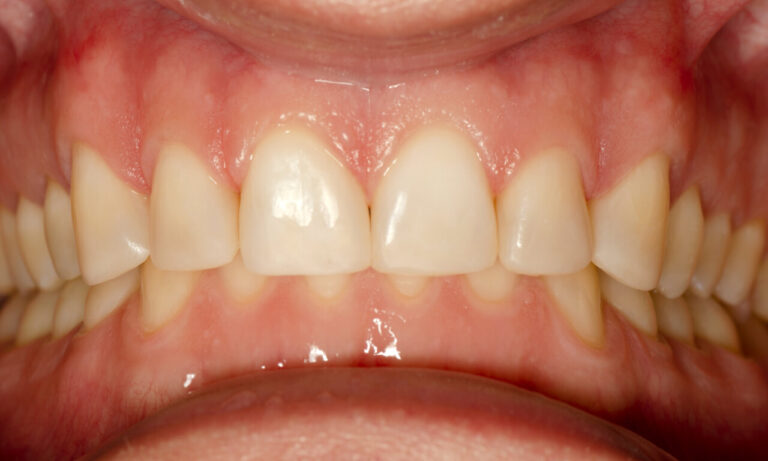 Posterior Composite Restoration. Photo after