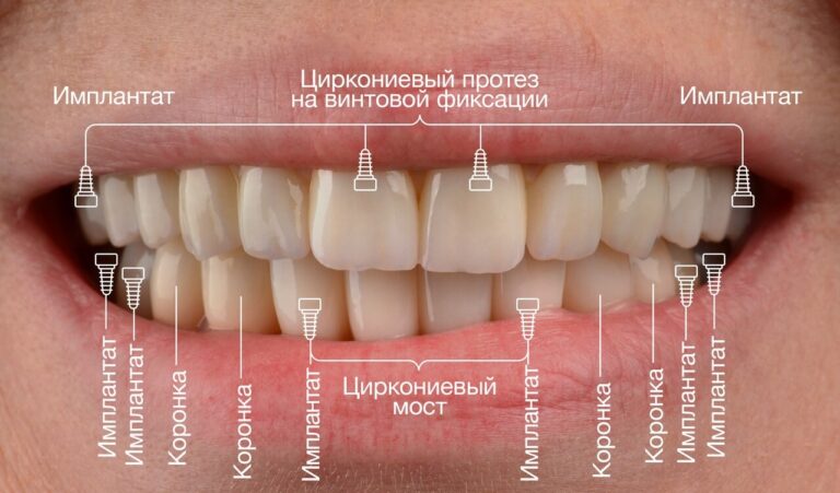 Преимущества All-on-4. Фото после