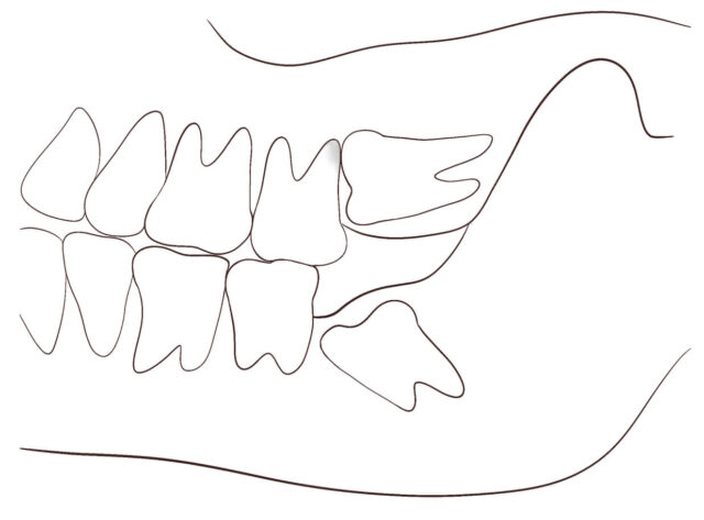 When is tooth extraction necessary? Illustration
