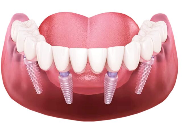 Implantation All-on-4
