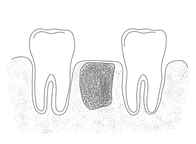 What is Bone augmentation? Illustration