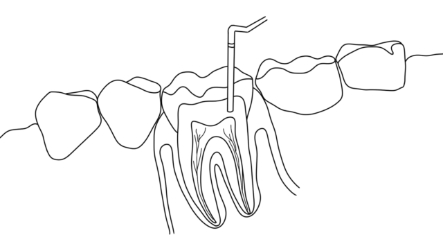 Signs of pulpitis Illustration