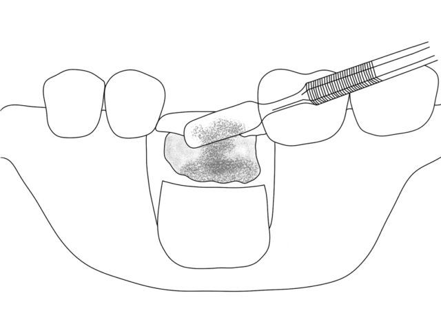 Causes of Bone Loss Illustration
