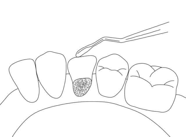 Allogeneic bone material. The advantages... Illustration
