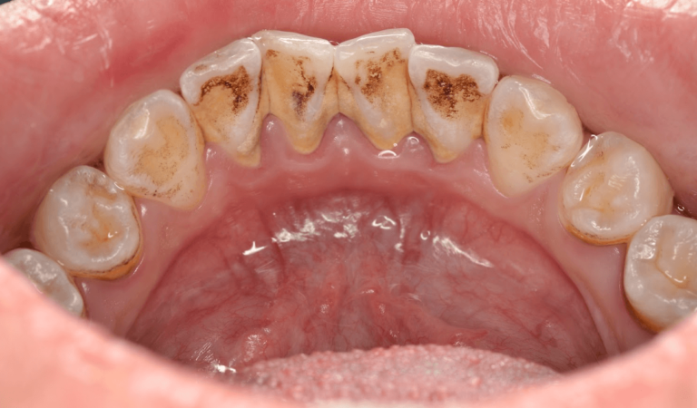 BENEFITS OF PROFESSIONAL TEETH CLEANING IN OUR CLINIC. Photo before