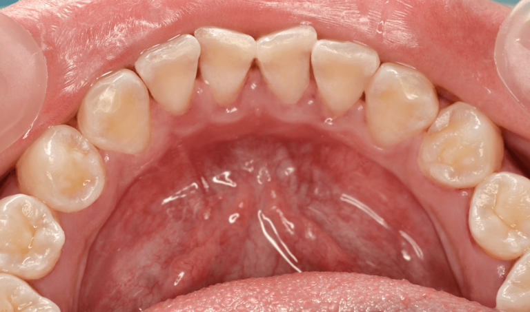 BENEFITS OF PROFESSIONAL TEETH CLEANING IN OUR CLINIC. Photo after