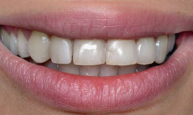 HOW IS DIRECT AESTHETIC RESTORATION PERFORMED?. Photo before