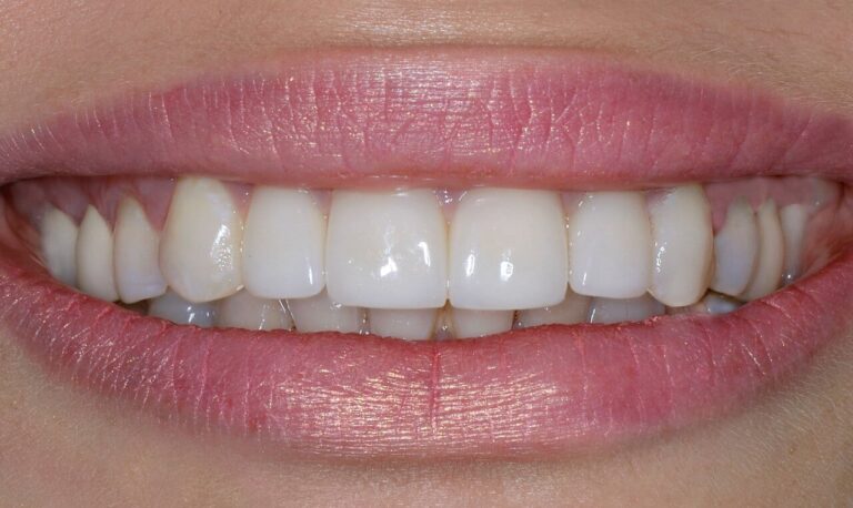 HOW IS DIRECT AESTHETIC RESTORATION PERFORMED?. Photo after
