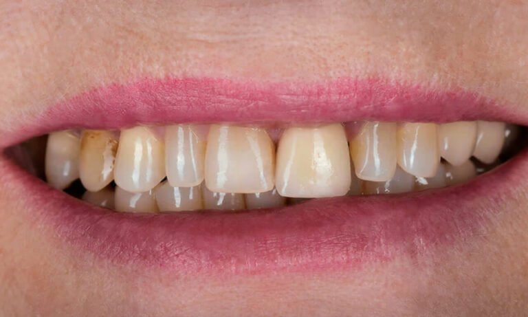 Zirconium. Photo before