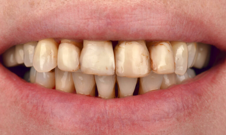 All-on-4 Benefits. Photo before