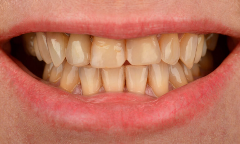 How Long Do Restorations Last?. Photo before