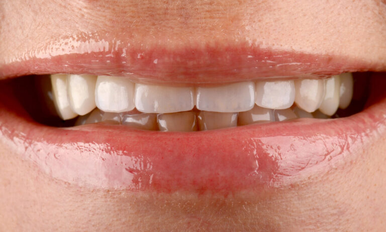 How Long Do Restorations Last?. Photo after