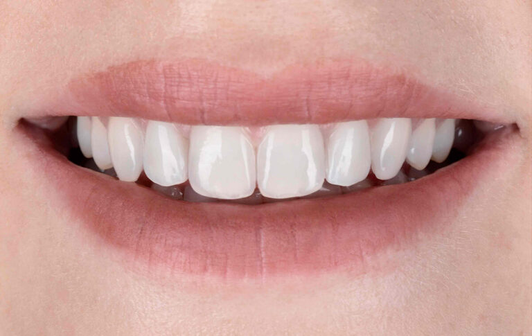 How long does a dental restoration last?. Photo after