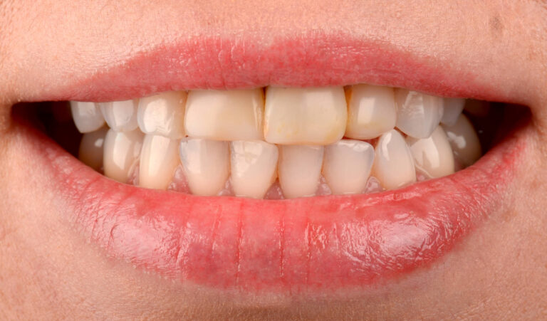 DENTAL RESTORATION METHODS. Photo before