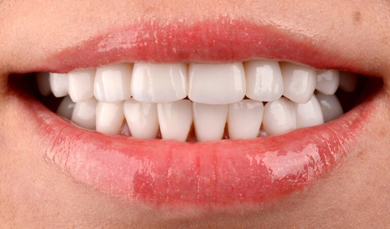 DENTAL RESTORATION METHODS. Photo after