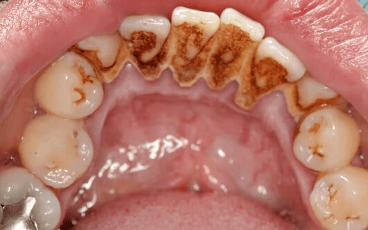 HOW DOES PROFESSIONAL TEETH CLEANING WORK?. Photo before