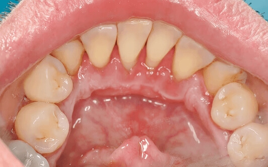 HOW DOES PROFESSIONAL TEETH CLEANING WORK?. Photo after