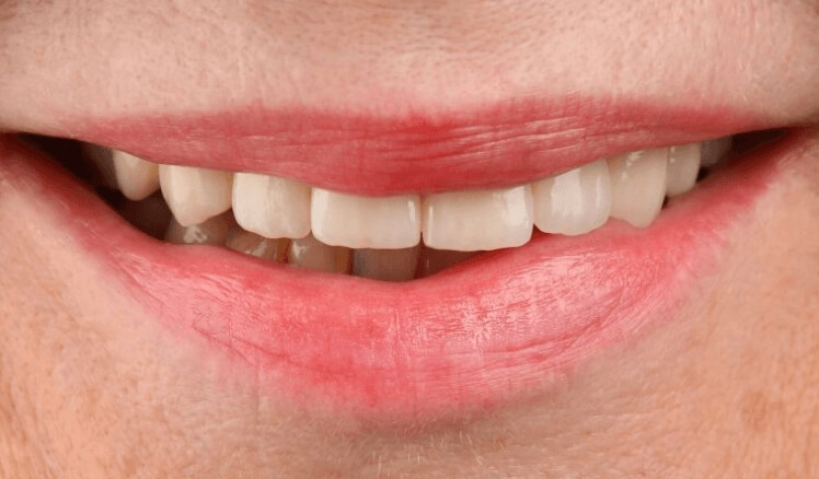 WHEN TO CONSIDER A DENTAL RESTORATION?. Photo before