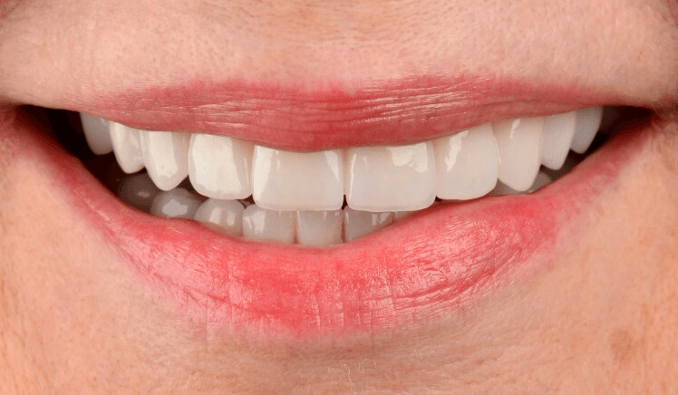 WHEN TO CONSIDER A DENTAL RESTORATION?. Photo after