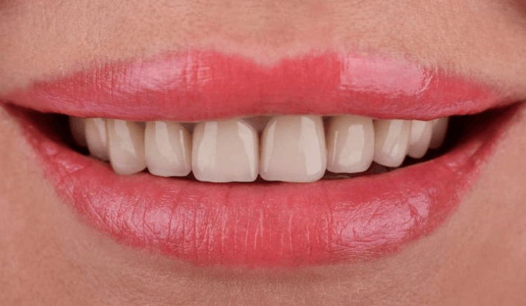 How Do You Know if You Need Veneers?. Photo before
