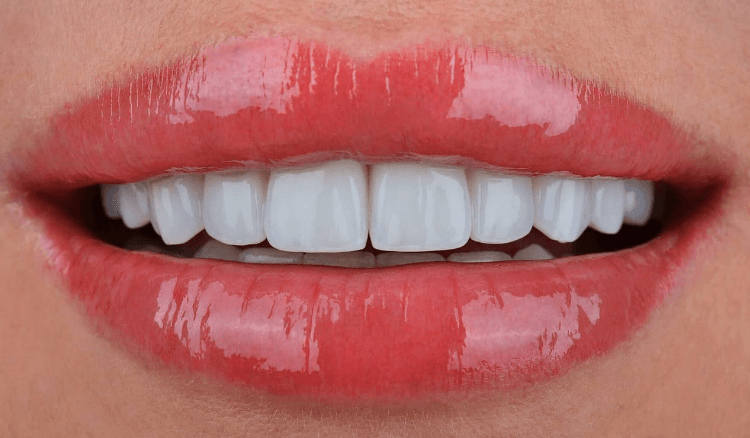 How Do You Know if You Need Veneers?. Photo after