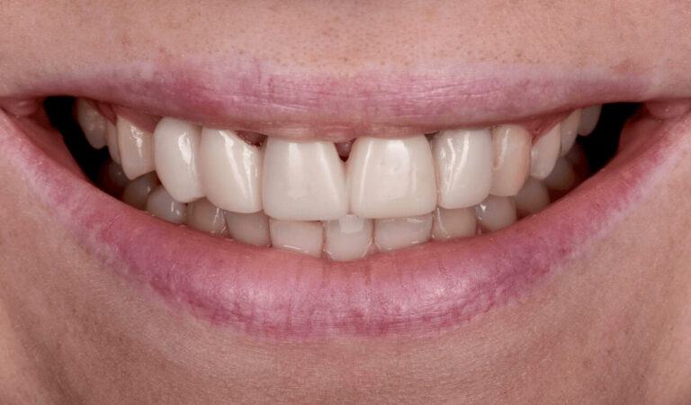 HOW IS INDIRECT AESTHETIC RESTORATION PERFORMED?. Photo before