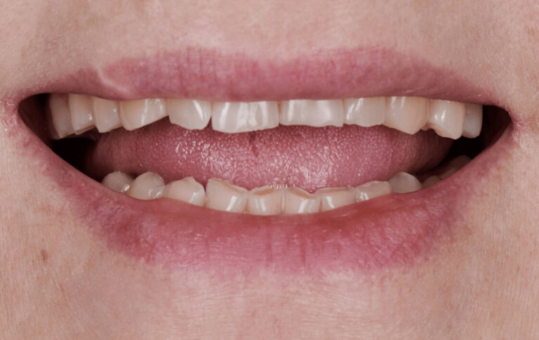 DENTAL RESTORATION VS. VENEERS. Photo before