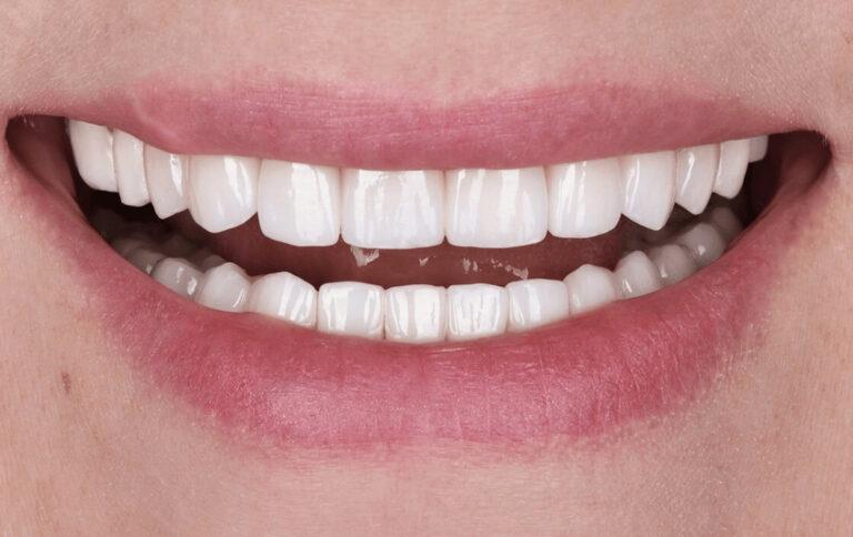 DENTAL RESTORATION VS. VENEERS. Photo after