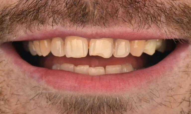 How are Veneers Installed?. Photo before